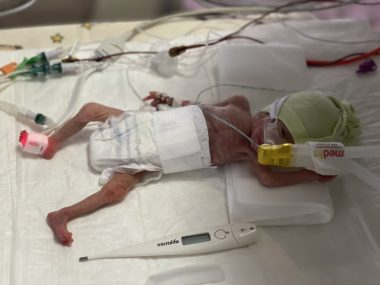 W Rudzie Śląskiej urodziła się dziewczynka ważąca 390 gramów Wcześniak Ruda śląska