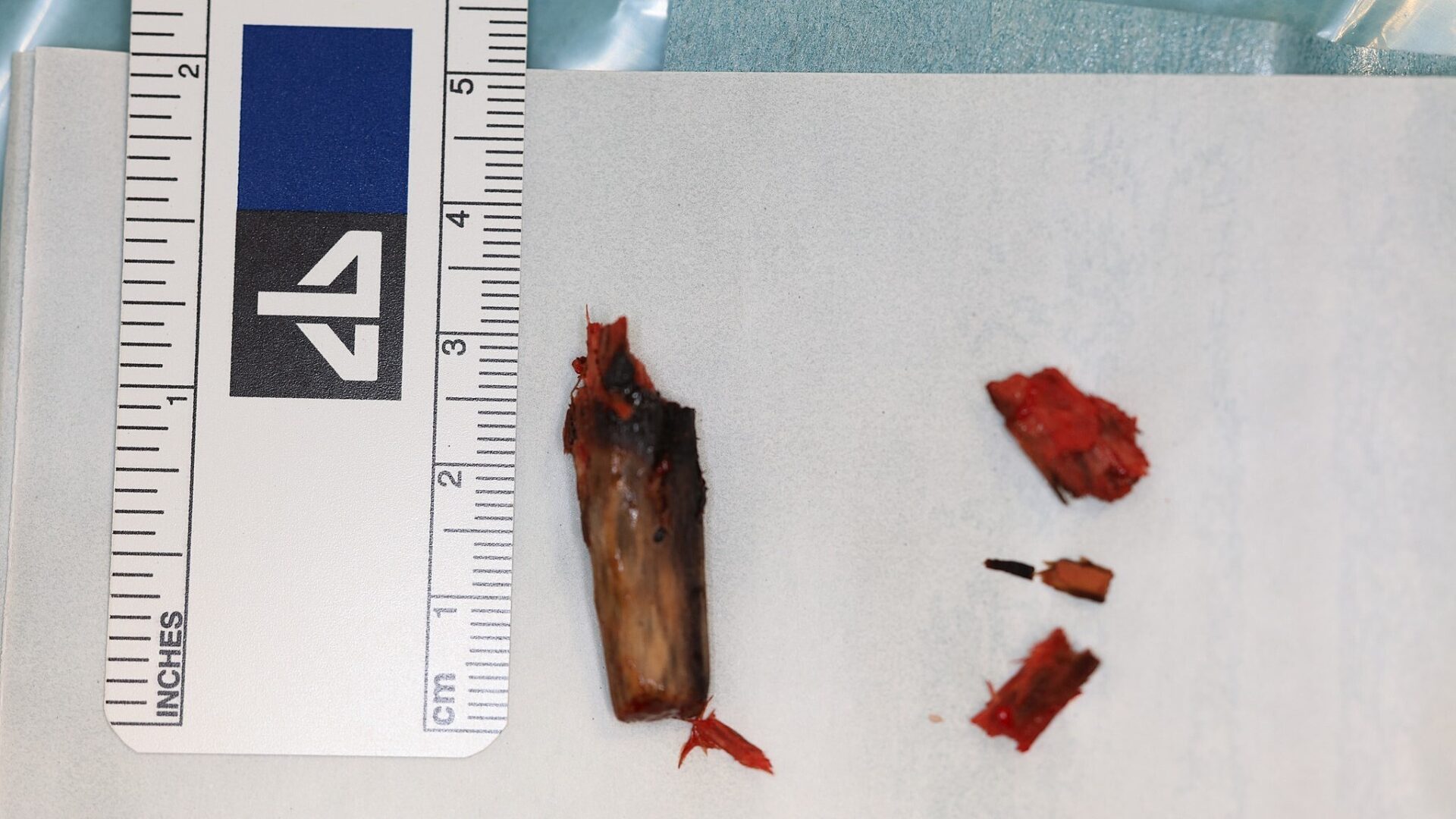 Centrum Zdrowia Dziecka drewno w policzku Centrum Zdrowia Dziecka drewno w policzku